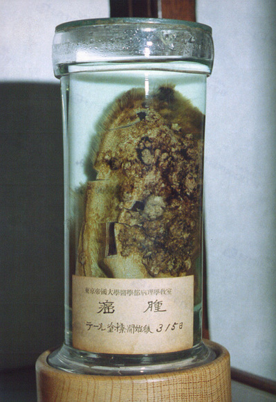 人工癌標本
